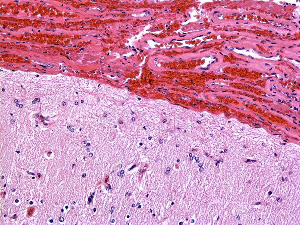 2A1 Astrocyte, subpial, (Case 18) 1