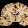 1A Dentate Gyrus Malformation (Case 6) gross _2