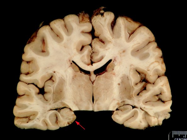 1A Dentate Gyrus Malformation (Case 6) gross _2