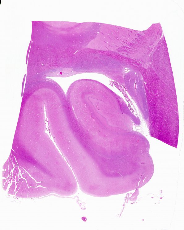 1B2 Dentate Malformation, unilateral (Case 6) non-affected side N11 H&E 0 whole mount