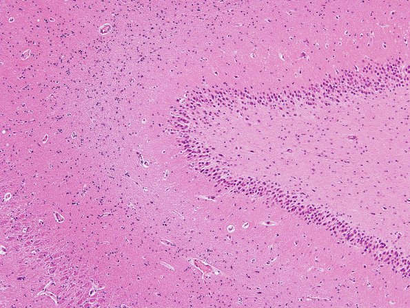 1B6 Dentate Malformation, unilateral (Case 6) non-affected side N11 H&E 8