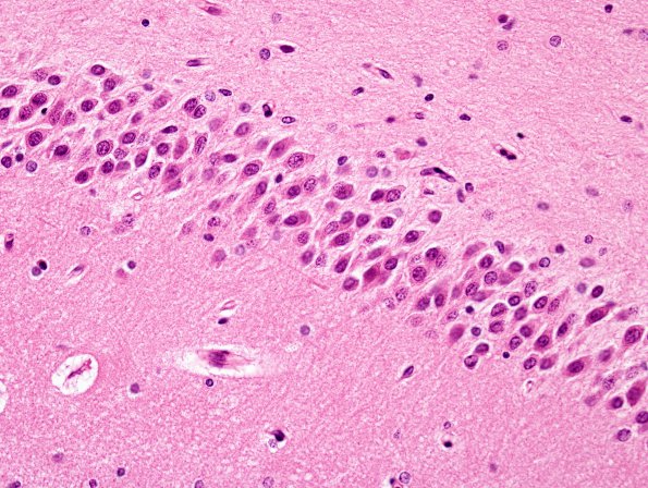 1B8 Dentate Malformation, unilateral (Case 6) non-affected side N11 H&E 2