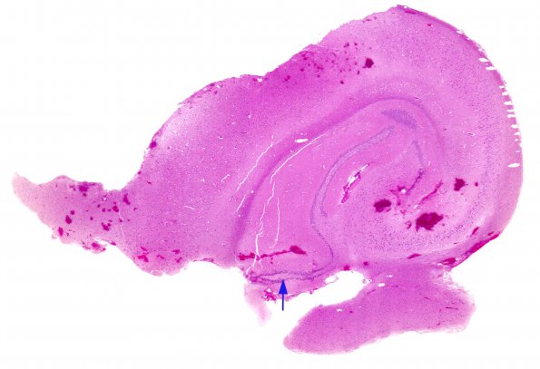 2A1 Dentate gyrus, duplication (Case 1) 2 H&E