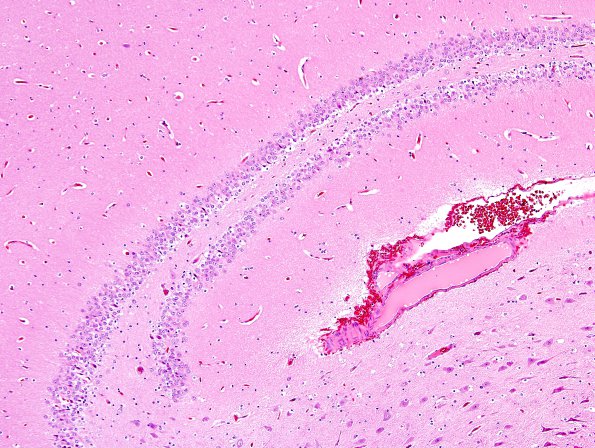 2A3 Dentate gyrus, duplication (Case 1) H&E 2