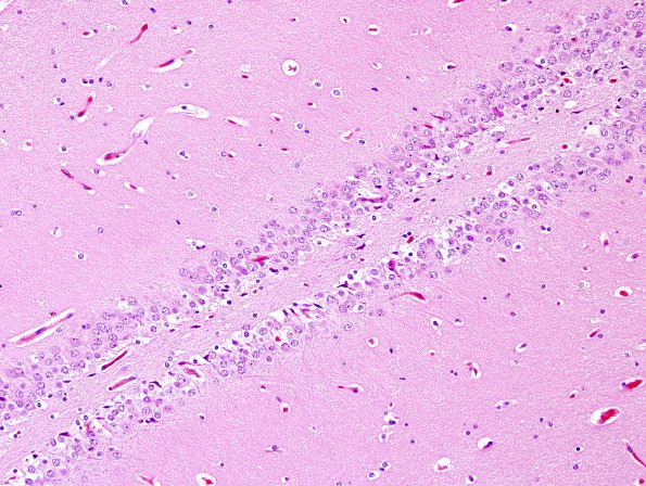 2A4 Dentate gyrus, duplication (Case 1) H&E 4