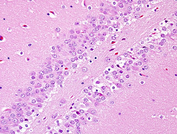 2A5 Dentate gyrus, duplication (Case 1) H&E 6