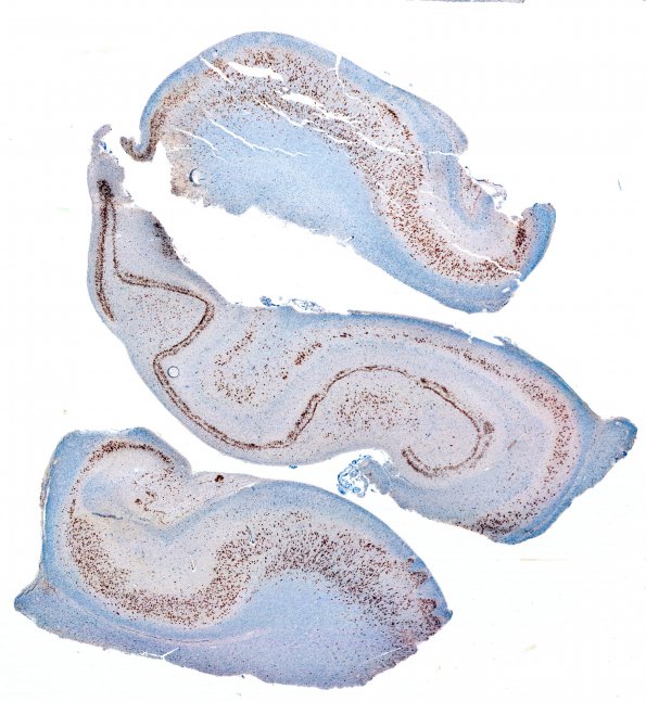 3B1 Dentate malformation, duplication  (Case 2) NeuN 1