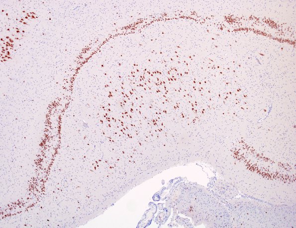 3B2 Dentate malformation, duplication (Case 2) NeuN 1