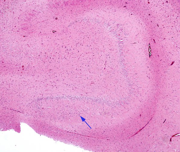 4A1 Dentate malformation, duplication (Case 3) H&E 1