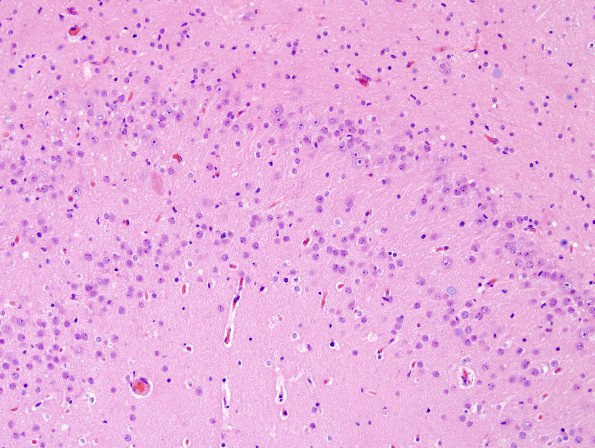 5A2 Dentate malformation, duplication (Case 4) H&E 3