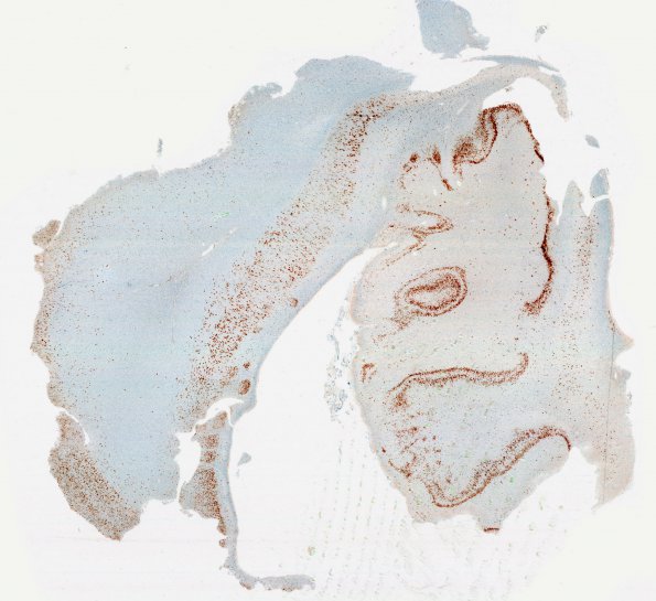 5B2 Dentate malformation, duplication (Case 4) NeuN 4