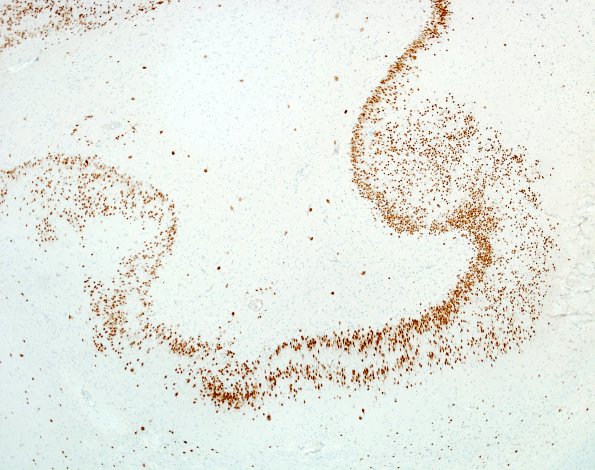 5B3 Dentate malformation, duplication (Case 4) NeuN 2