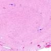 7A1 Epilepsy, dentate nodules (Case 7) H&E 4 copy