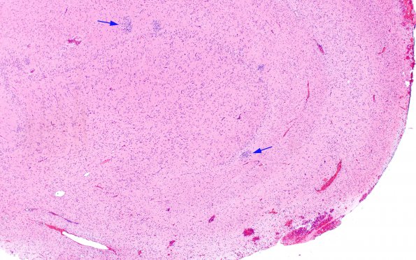 7A1 Epilepsy, dentate nodules (Case 7) H&E 4 copy