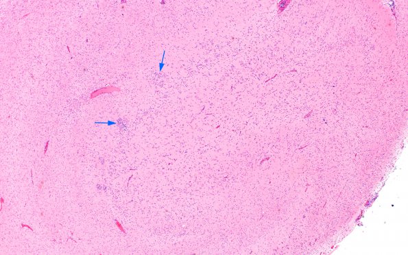 7A2 Epilepsy, dentate nodules (Case 7) H&E 5 copy