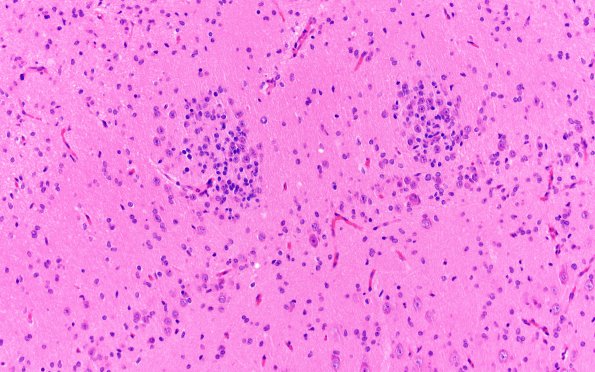 7A3 Epilepsy, dentate nodules (Case 7) H&E 3