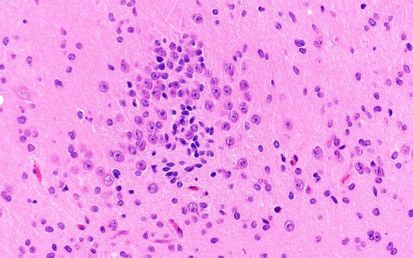 7A4 Epilepsy, dentate nodules (Case 7) H&E 6.jpg