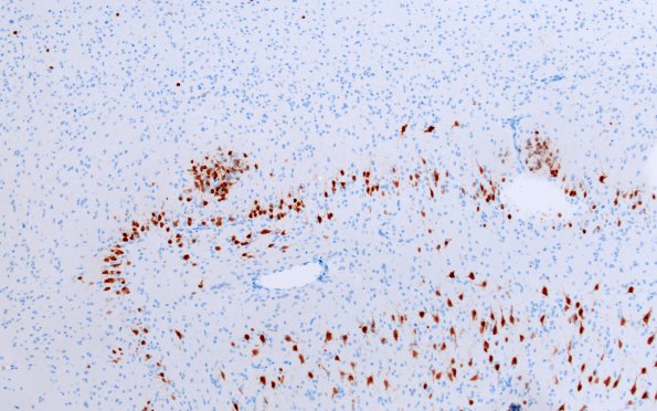 7B2 Epilepsy, dentate nodules (Case 7) NeuN 3