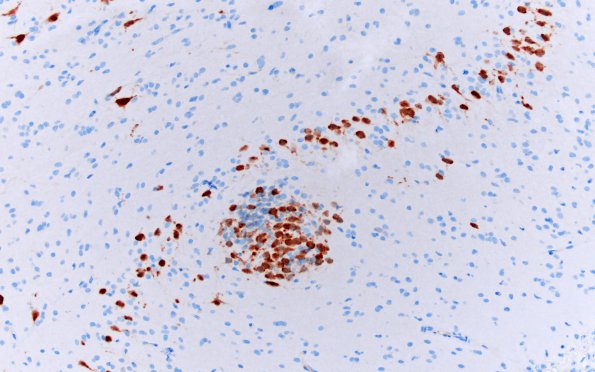 7B3 Epilepsy, dentate nodules (Case 7) NeuN 4