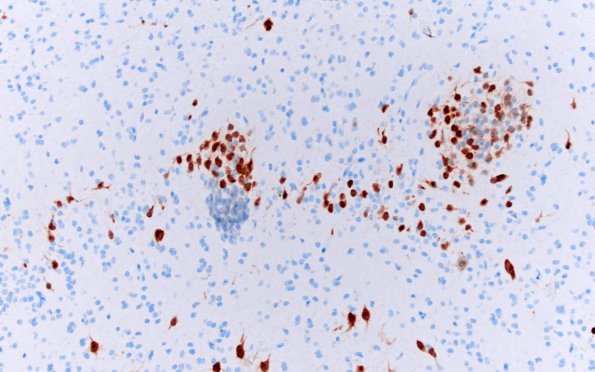 7B4 Epilepsy, dentate nodules (Case 7) NeuN 6