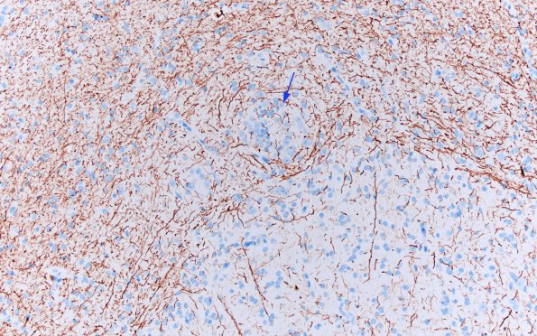 7C1 Epilepsy, dentate nodules (Case 7) NF 6 copy