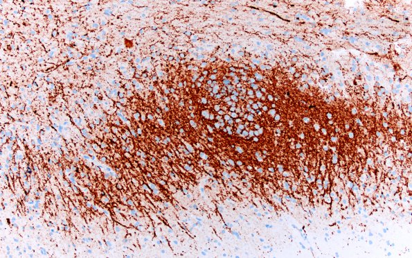 7D Epilepsy, dentate nodules (Case 7) Synaptophysin 4