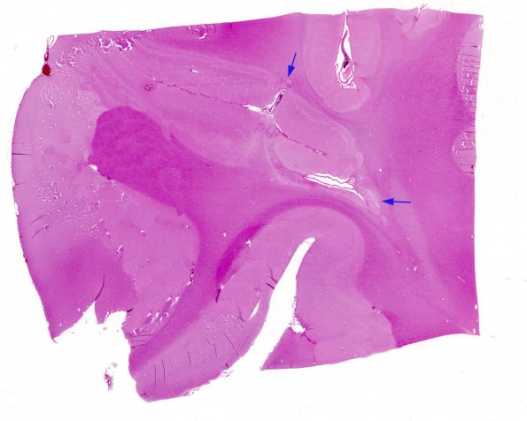 1A Encephalomalacia, Remote (Case 2)  1 H&E whole mount