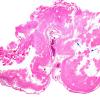 2A1 Encephalomalacia, static, remote (aka cerebral palsy, Case 1) H&E 2X