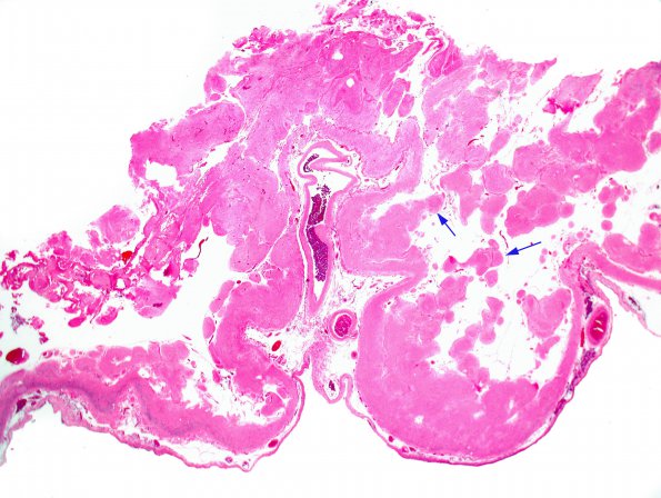 2A1 Encephalomalacia, static, remote (aka cerebral palsy, Case 1) H&E 2X
