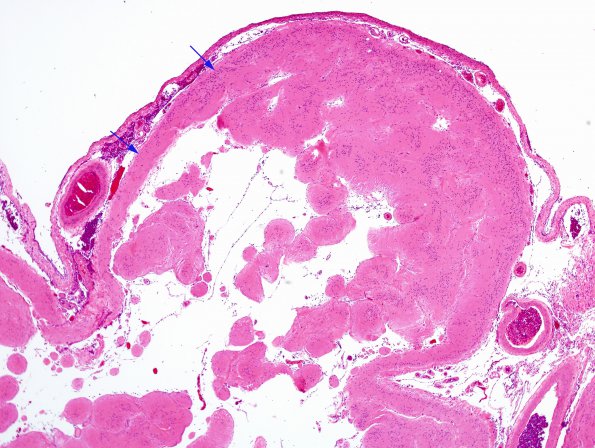 2A2 Encephalomalacia, static, remote (aka cerebral palsy, Case 1) H&E 3