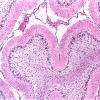 1A2 Granule Cell Loss, chronic seizures (Case 1) H&E 2