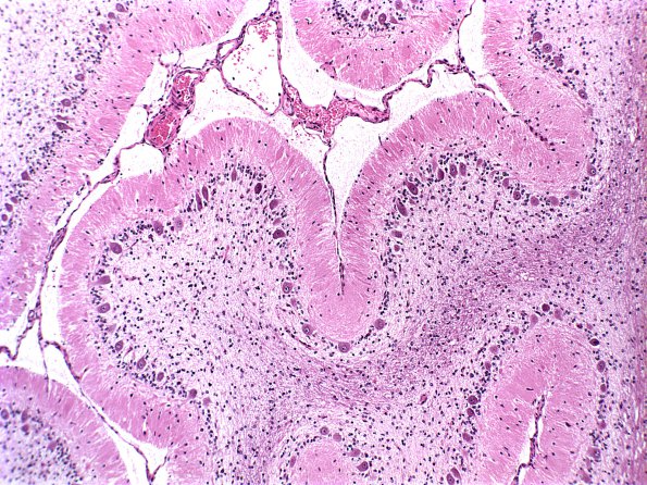 1A2 Granule Cell Loss, chronic seizures (Case 1) H&E 2