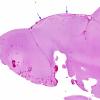 6A1 Complex Malformation (Case 7) 4 Grid Effect