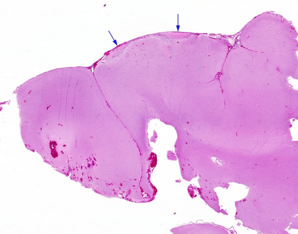 6A1 Complex Malformation (Case 7) 4 Grid Effect