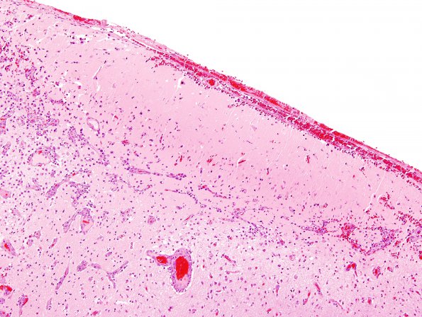 6A2 Complex Malformation (Case 7) 3 Grid Effect