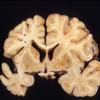 1 Hemiatrophy with Seizures (Case 1)