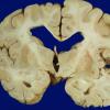 2 Hemiatrophy with Seizures (Case 2)