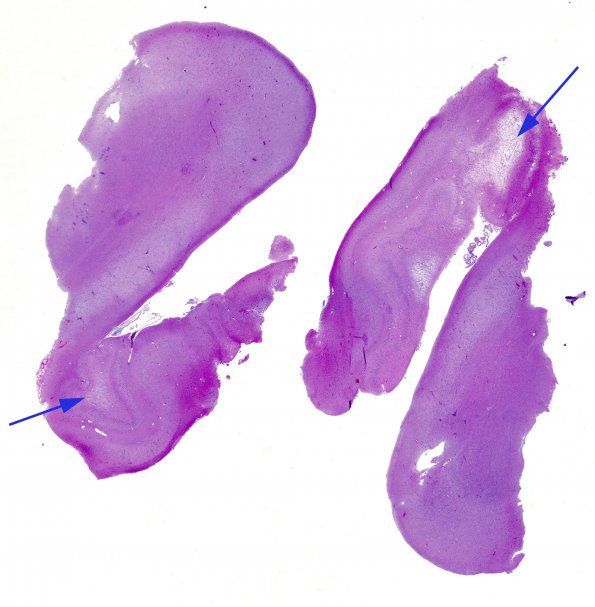 1A1 Hippocampal Sclerosis & Dysplasia (Case 1) H&E whole mount