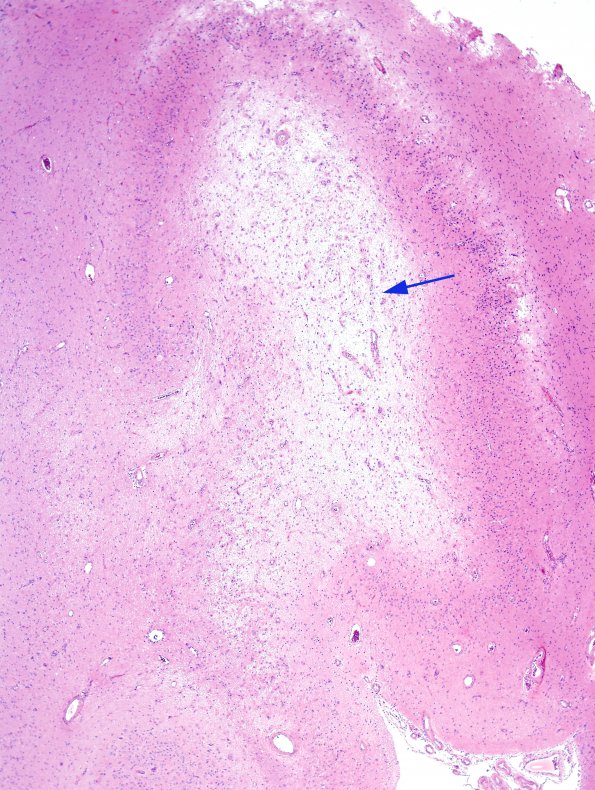 1A2 Hippocampal Sclerosis & Dysplasia (Case 1) H&E 6