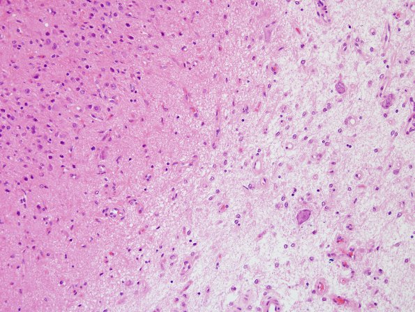 1A3 Hippocampal Sclerosis & Dysplasia (Case 1) H&E 5