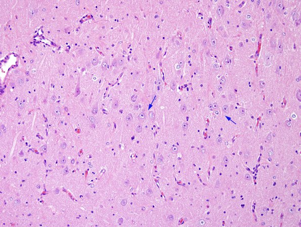 1A5 Hippocampal Sclerosis & Dysplasia (Case 1) H&E 2