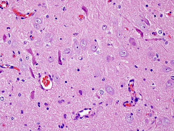 1A6 Hippocampal Sclerosis & Dysplasia (Case 1) H&E 1