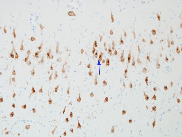 1B Hippocampal Sclerosis & Dysplasia (Case 1) NeuN 1