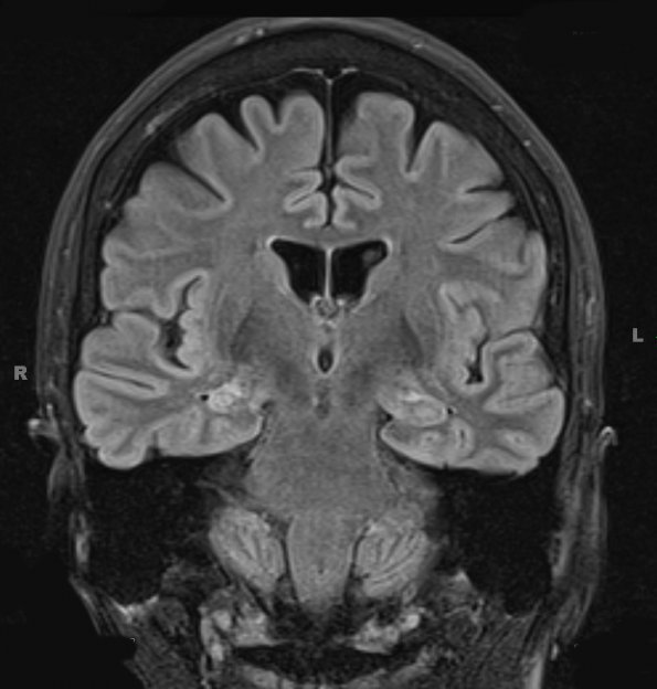 1 Hippocampal sclerosis (Mesial temporal sclerosis, Case 1) COR FLAIR