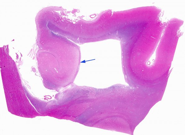 10A1 Hippocampal sclerosis, chronic epilepsy (Case 10) H&E whole mount