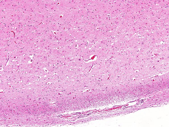 10A2 Hippocampal sclerosis, chronic epilepsy  (Case 10) H&E 1A