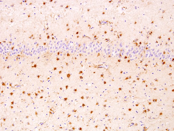 10B2 Hippocampal sclerosis, chronic epilepsy (Case 10) GFAP 1