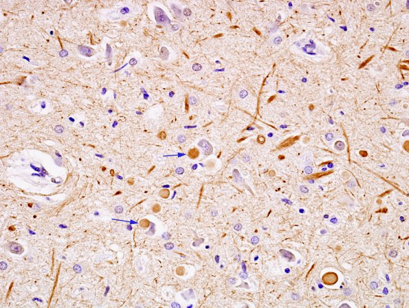 10B3 Hippocampal sclerosis, chronic epilepsy (Case 10) SMI 31