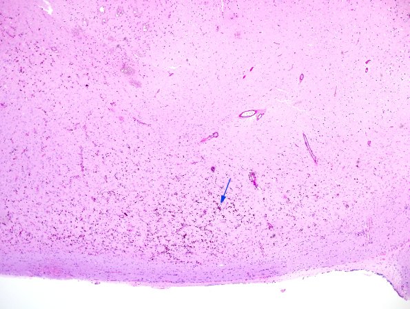 11A1 Hippocampal Sclerosis (Case 14) PAS 4A