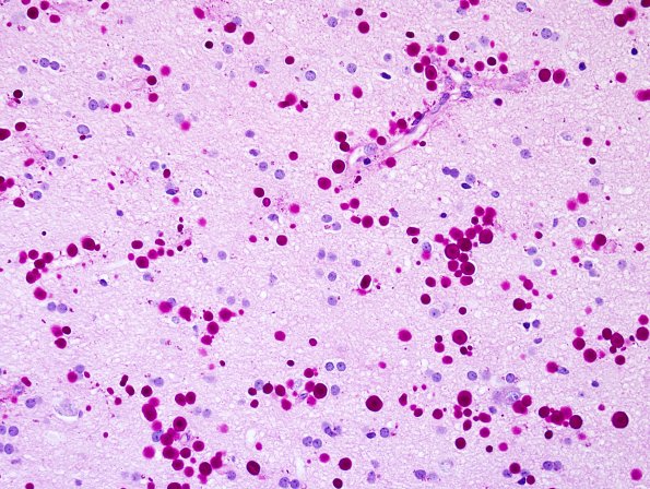 11A2 Hippocampal Sclerosis (Case 11) PAS 3